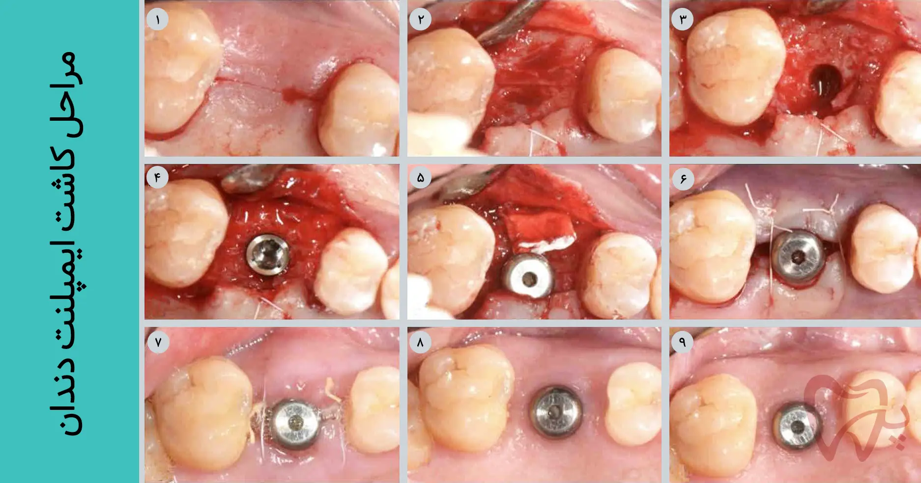 ایمپلنت دندان کلینیک تخصصی دندانپزشکی پارسا