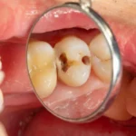 چگونه از پوسیدگی دندان پیشگیری کنیم؟ راهنمای جامع برای لبخندی سالم