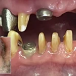کاشت ایمپلنت دندان، مراحل و مزایای آن